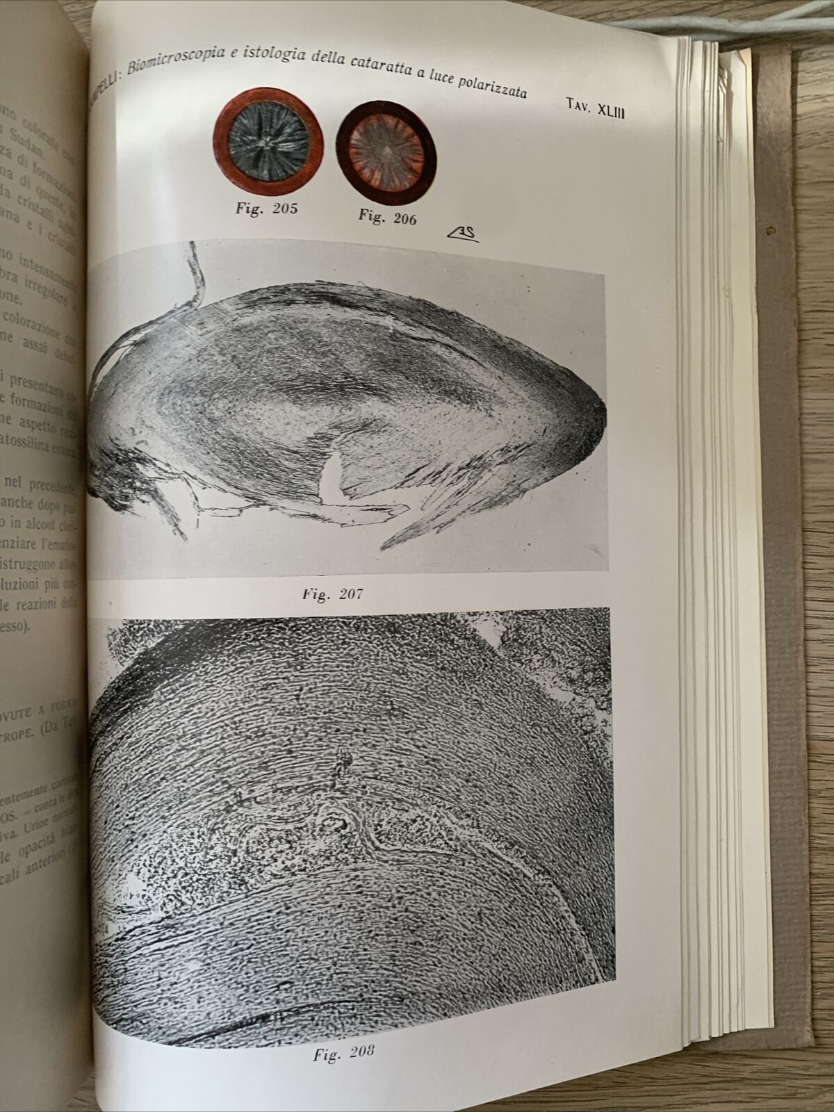 BIOMICROSCOPIA ED ISTOLOGIA DELLA CATARATTA A LUCE POLARIZZATA - Strampelli 1934