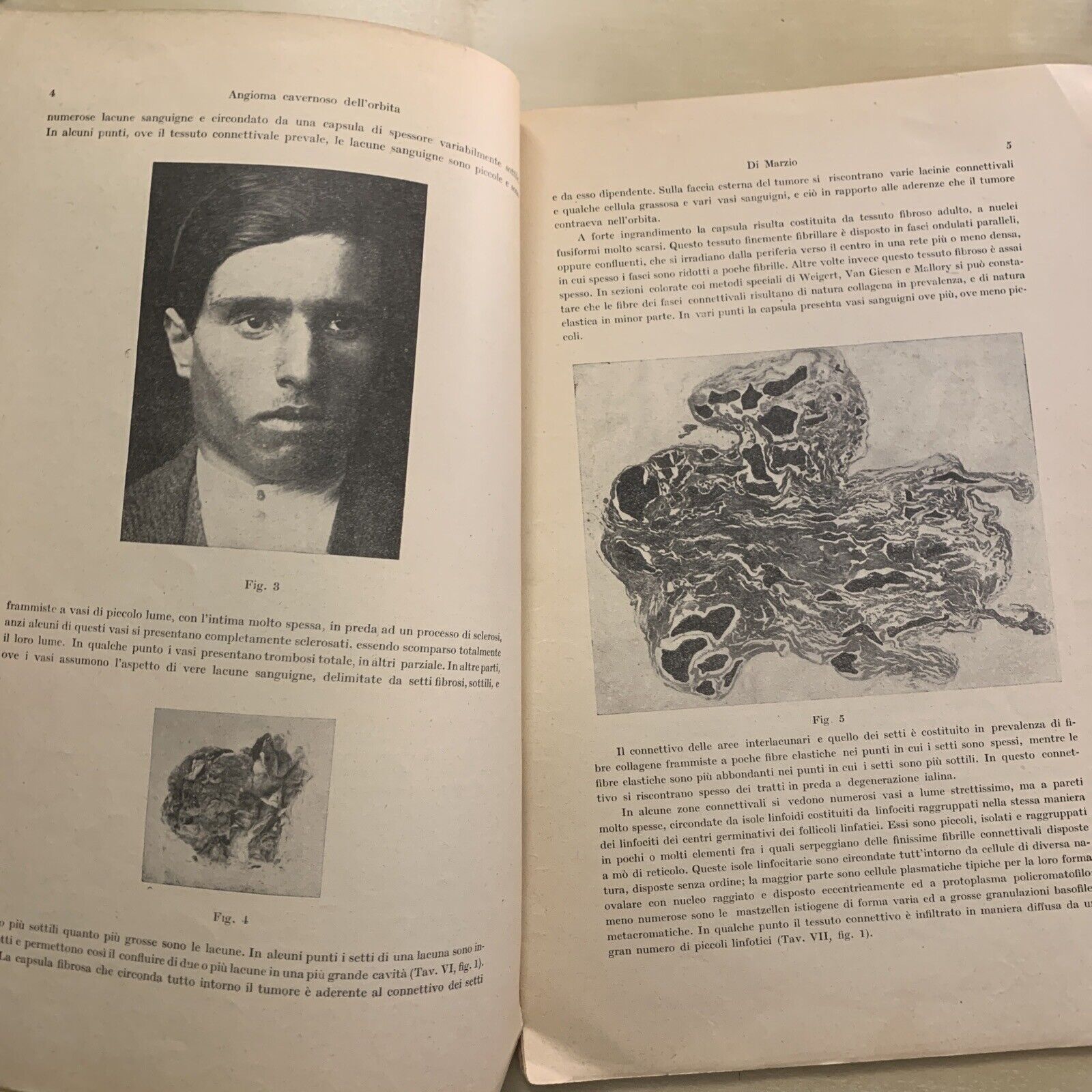 ANGIOMA CAVERNOSO DELL'ORBITA - Quirino di Marzio. Oculistica Oftalmologia 1923