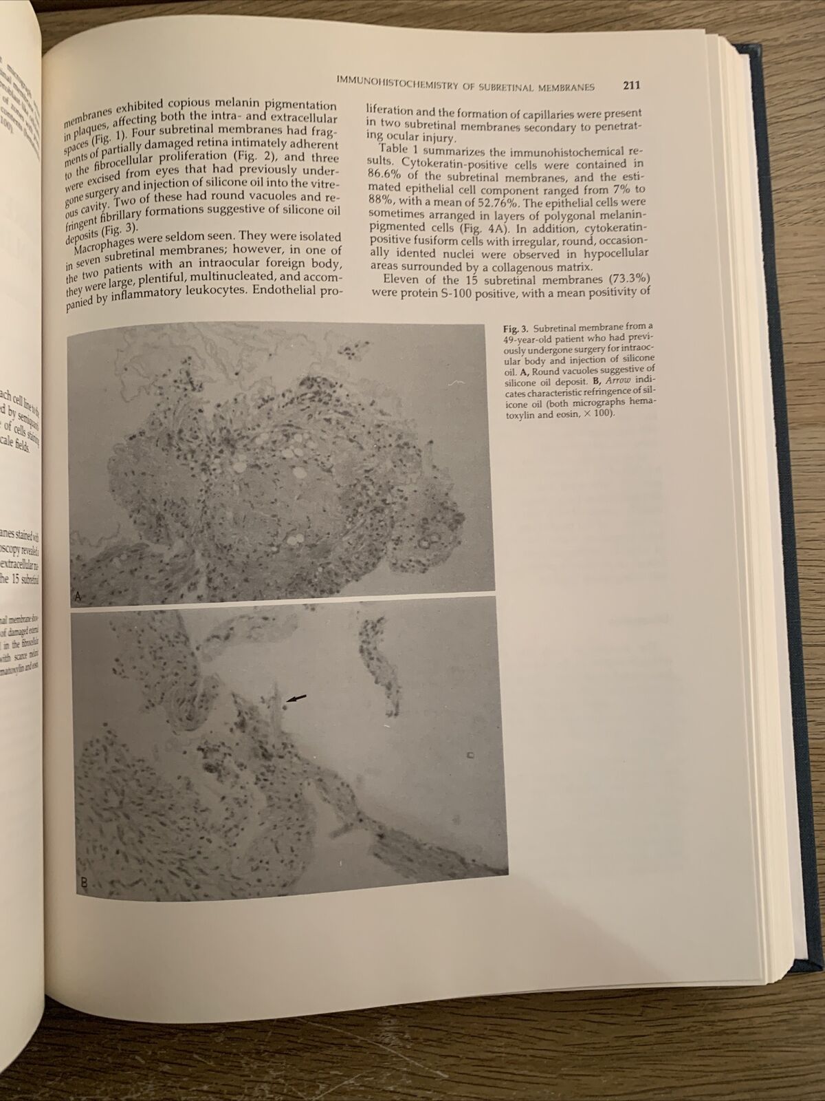 ADVANCES IN VITREORETINAL SURGERY. G.B BIETTI. MARIO STIRPE 1992