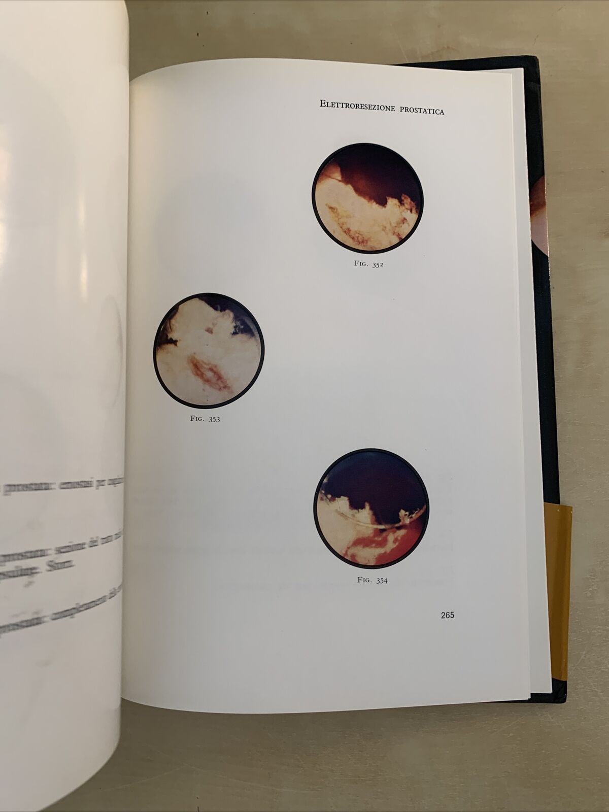 UROLOGIA ENDOSCOPICA - Rocca Rossetti, Usai, Binaghi. Editrice Universo 1970 #