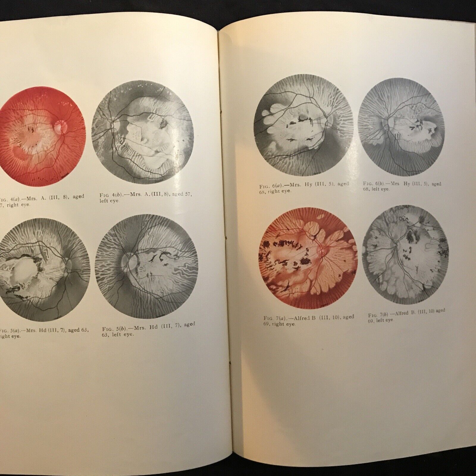 BRITISH JOURNAL OF OPHTHALMOLOGY oftalmologia, vol. XXXIV 1950 - S. Duke-Elder