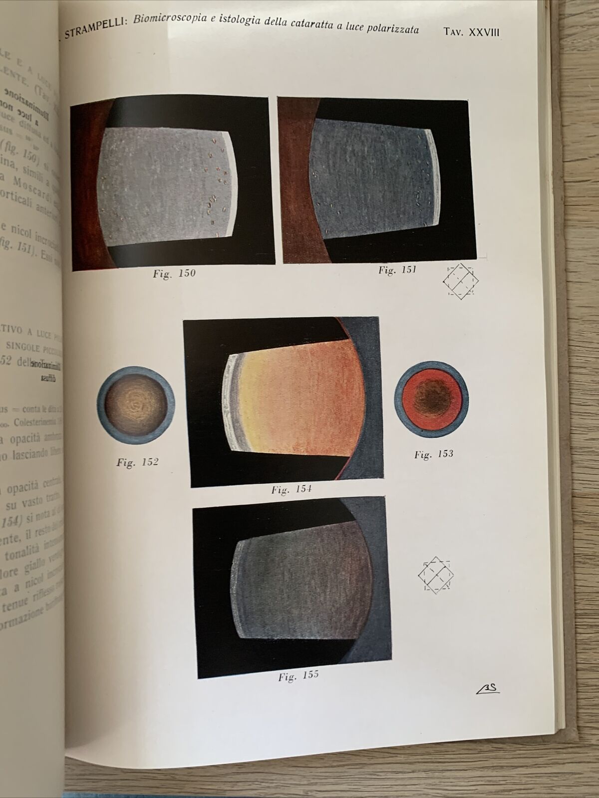 BIOMICROSCOPIA ED ISTOLOGIA DELLA CATARATTA A LUCE POLARIZZATA - Strampelli 1934