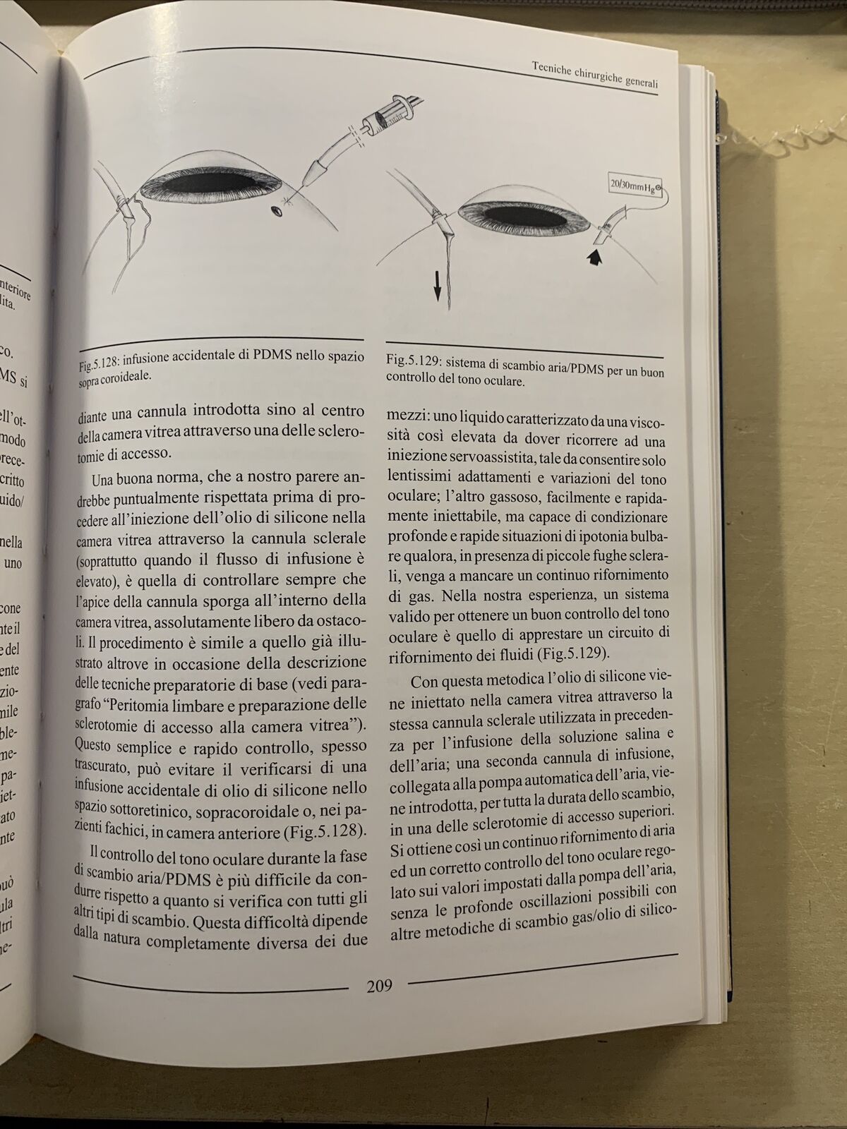 LA CHIRURGIA VITREORETINICA NEL DISTACCO DI RETINA REGMATOGENO. Molfetta Ghedini