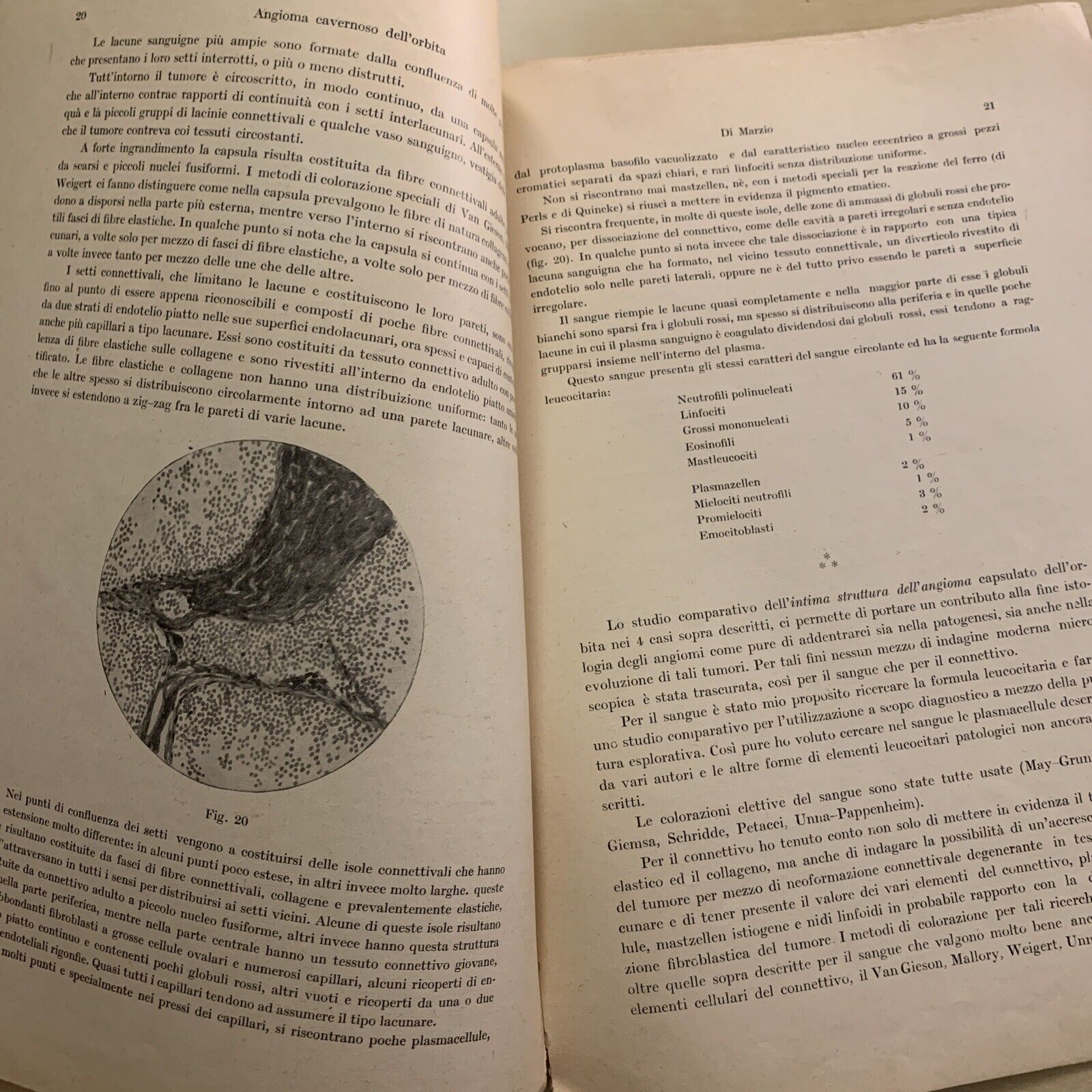 ANGIOMA CAVERNOSO DELL'ORBITA - Quirino di Marzio. Oculistica Oftalmologia 1923