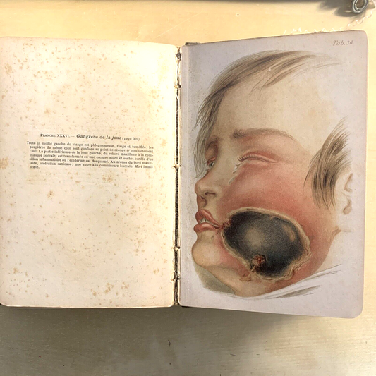 ATLAS MANUEL MALADIES DES ENFANTS. Hecker Trump Apert. Baillière & Fils 1906 #
