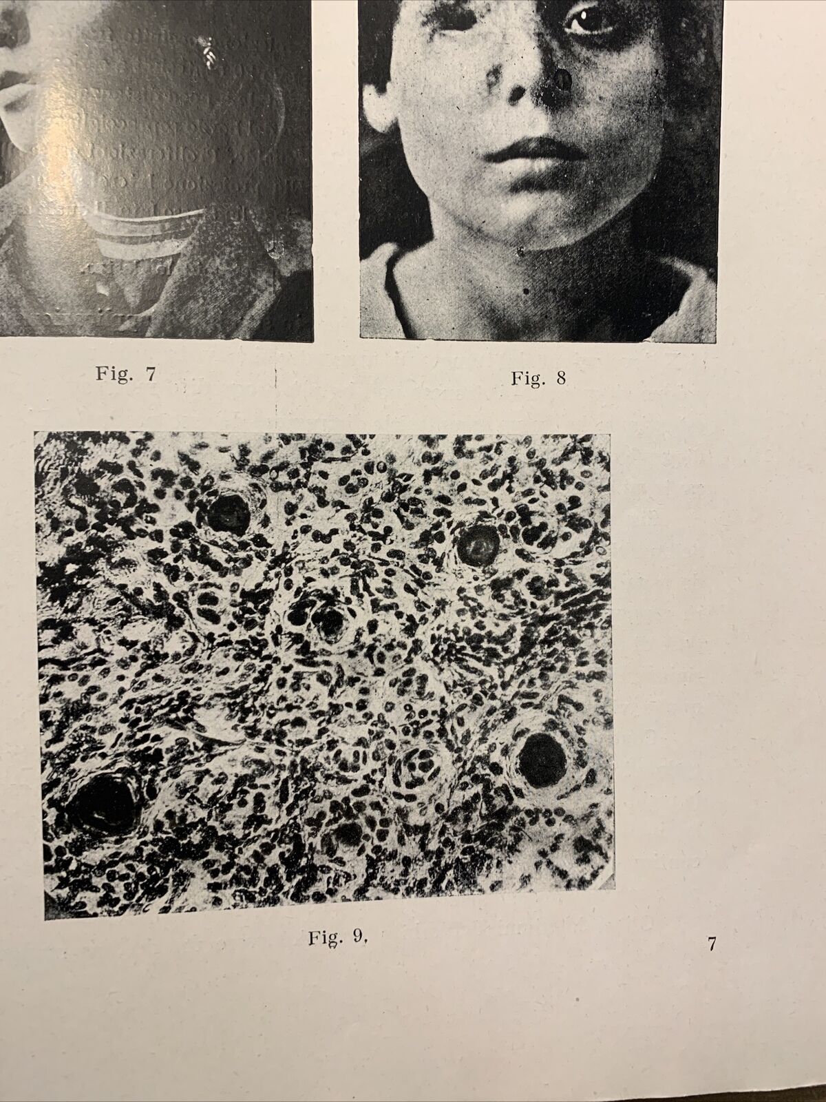 SAGGI DI OFTALMOLOGIA - clinica oculistica di Roma. Prof di Marzio 1927. vol 3 #