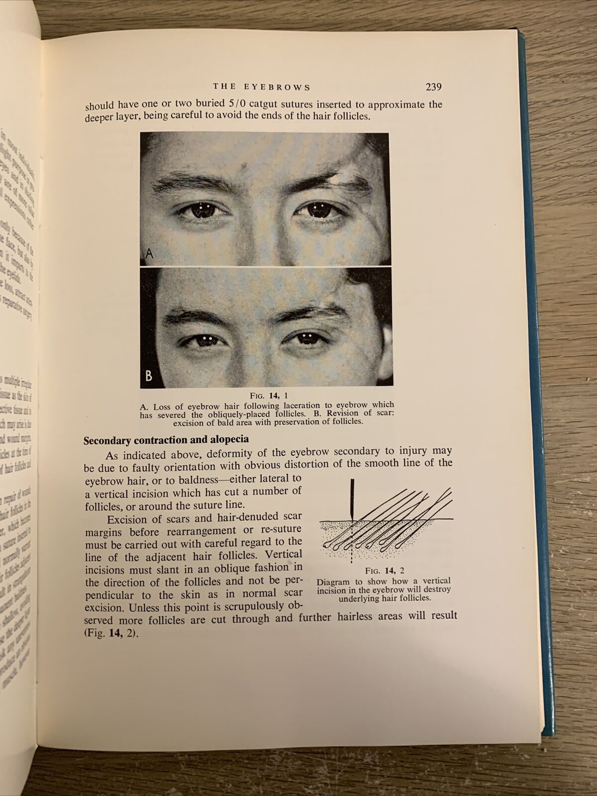 REPAIR AND RECONSTRUCTION IN THE ORBITAL REGION - MUSTARDÉ J. C. Churchill 1971