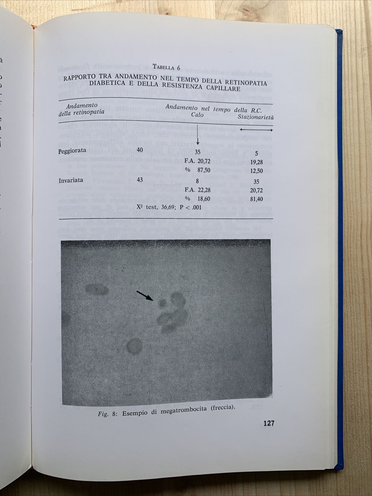 LA RETINOPATIA DIABETICA - BRANCATO POZZA, epidemiologia, patogenesi, diagnosi #
