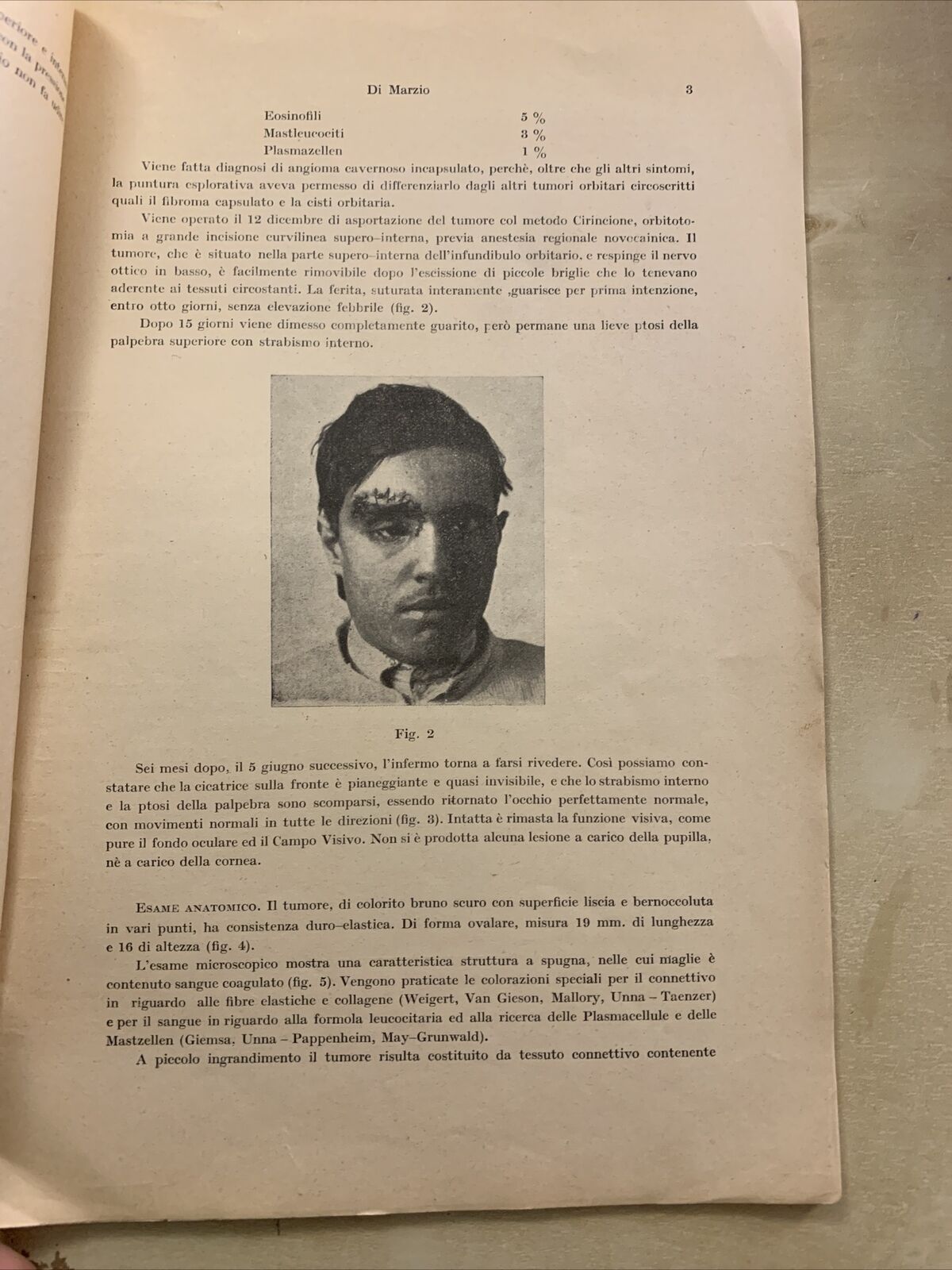 ANGIOMA CAVERNOSO DELL'ORBITA - Quirino di Marzio. Oculistica Oftalmologia 1923