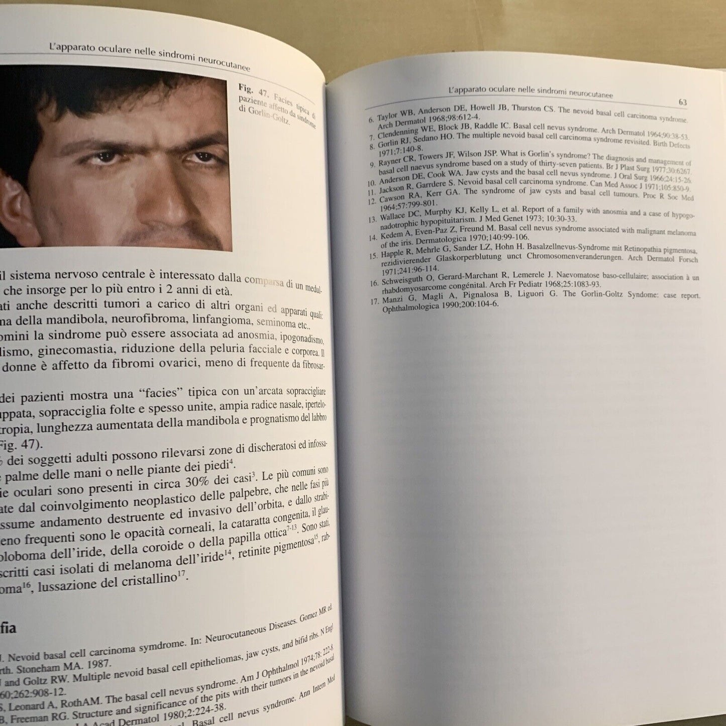 L'APPARATO OCULARE NELLE SINDROMI NEUROCUTANEE - Santi Maria recupero. Verduci #