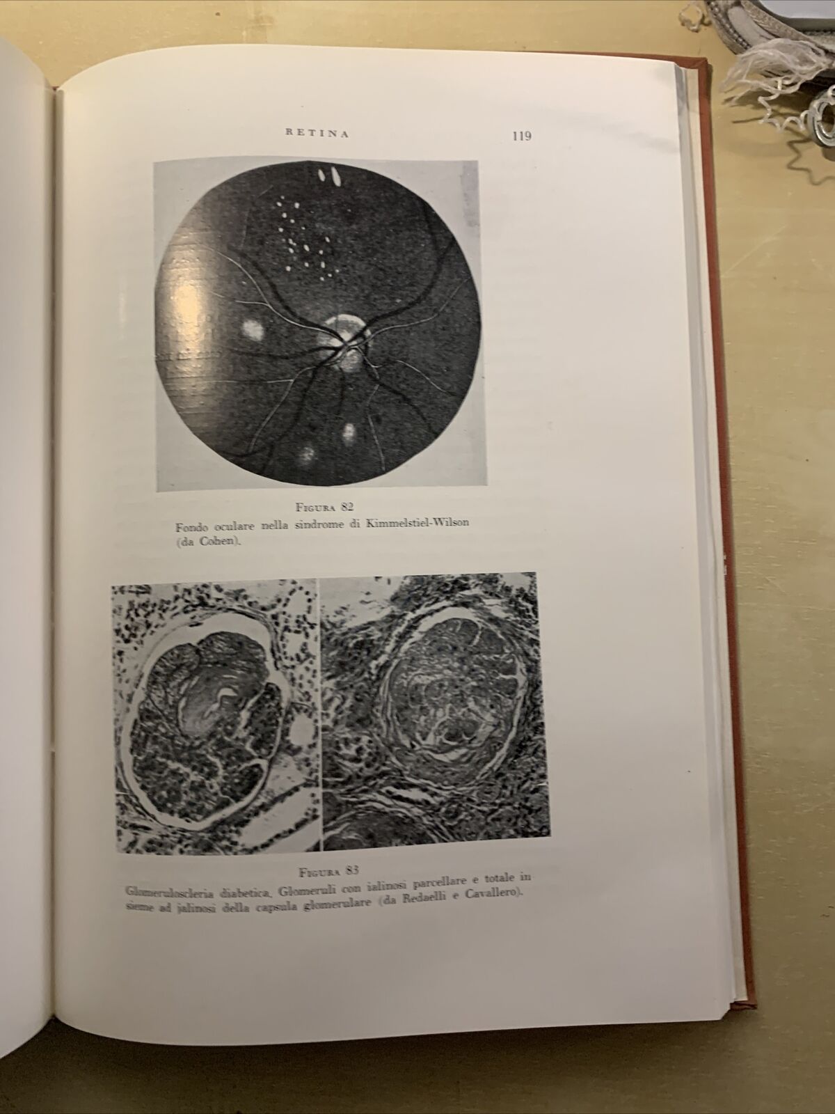 L'OCCHIO NEL DIABETE MELLITO - ALAGNA, SCULLICA, CASA EDITRICE G. D'ANNA 1956 #