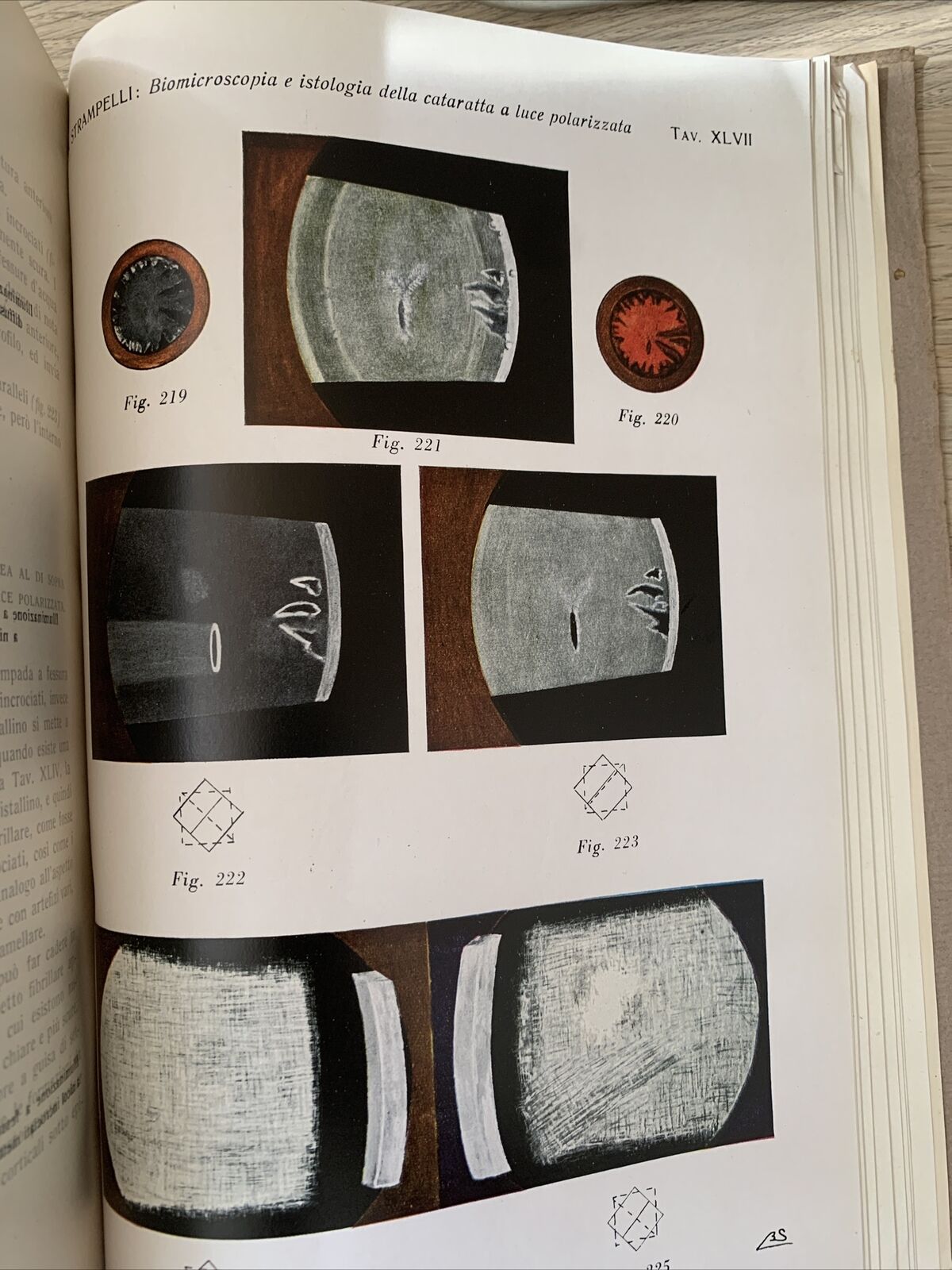 BIOMICROSCOPIA ED ISTOLOGIA DELLA CATARATTA A LUCE POLARIZZATA - Strampelli 1934