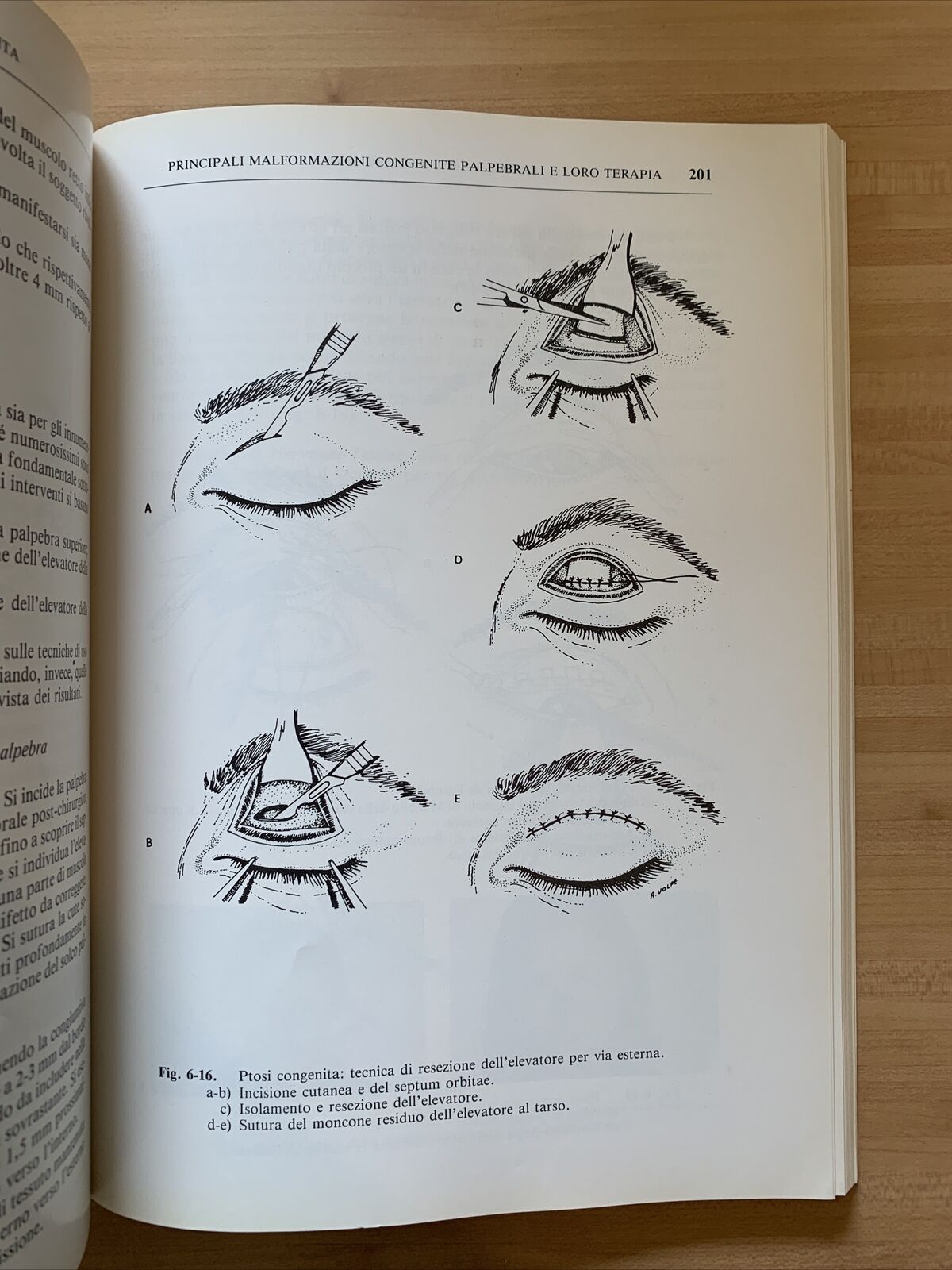 MALATTIE CONGENITE DELL'APPARATO OCULARE - Trattamento chirurgico. G. Scuderi