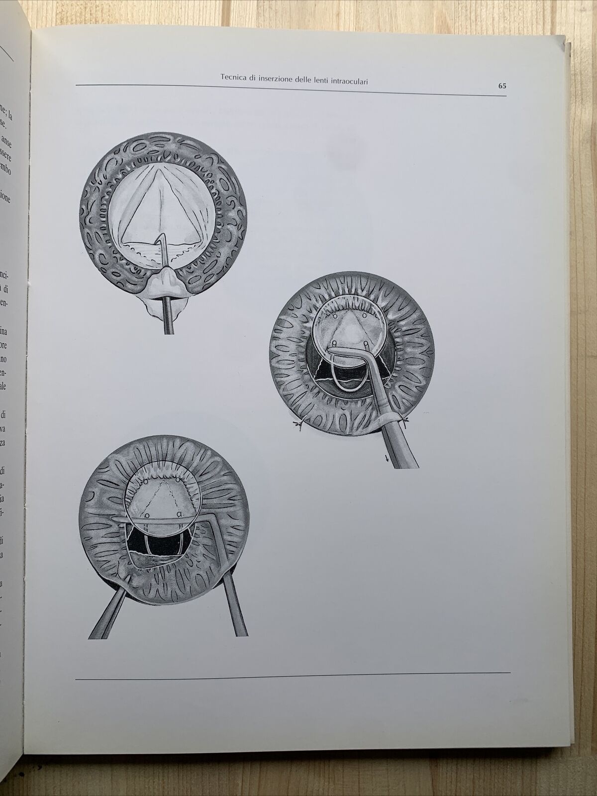 ATLANTE DI LENTI INTRAOCULARI - Lucio Buratto 1984 #