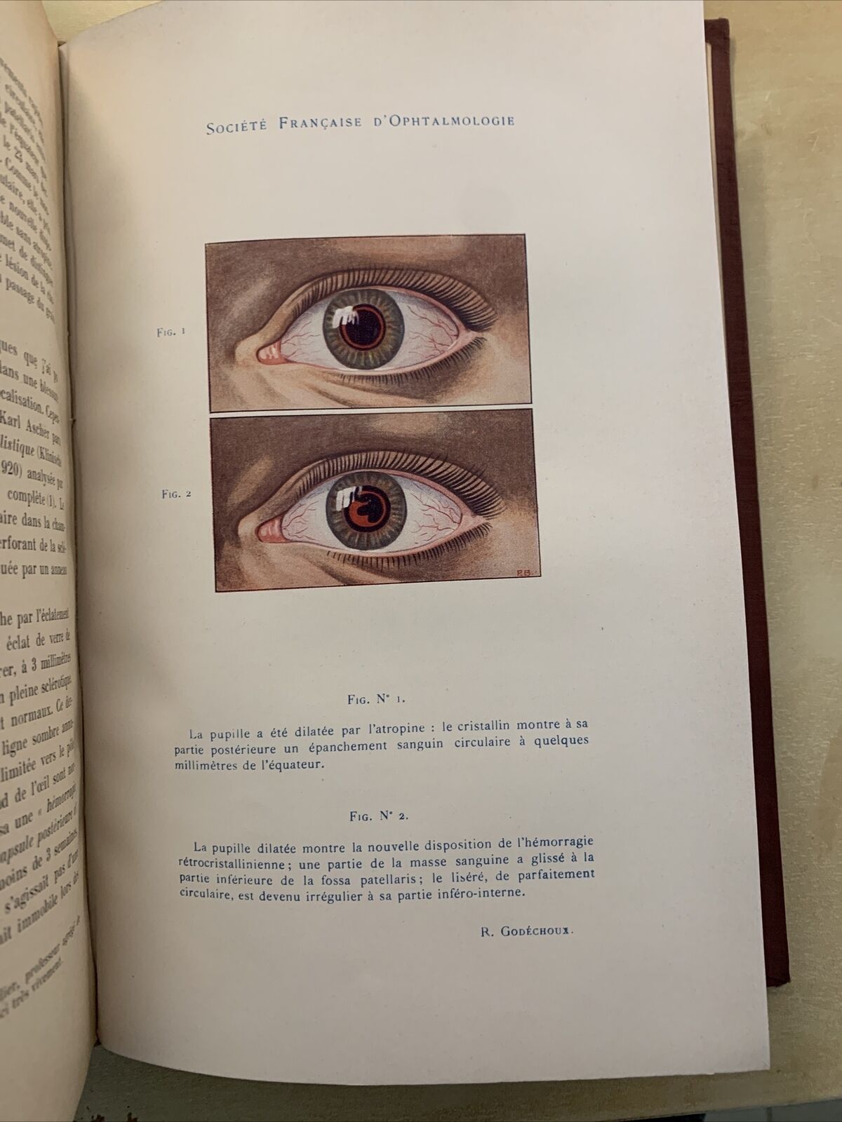 Bulletins et memoires de la société francaise d'ophtalmologie vol. XXXVI 1923