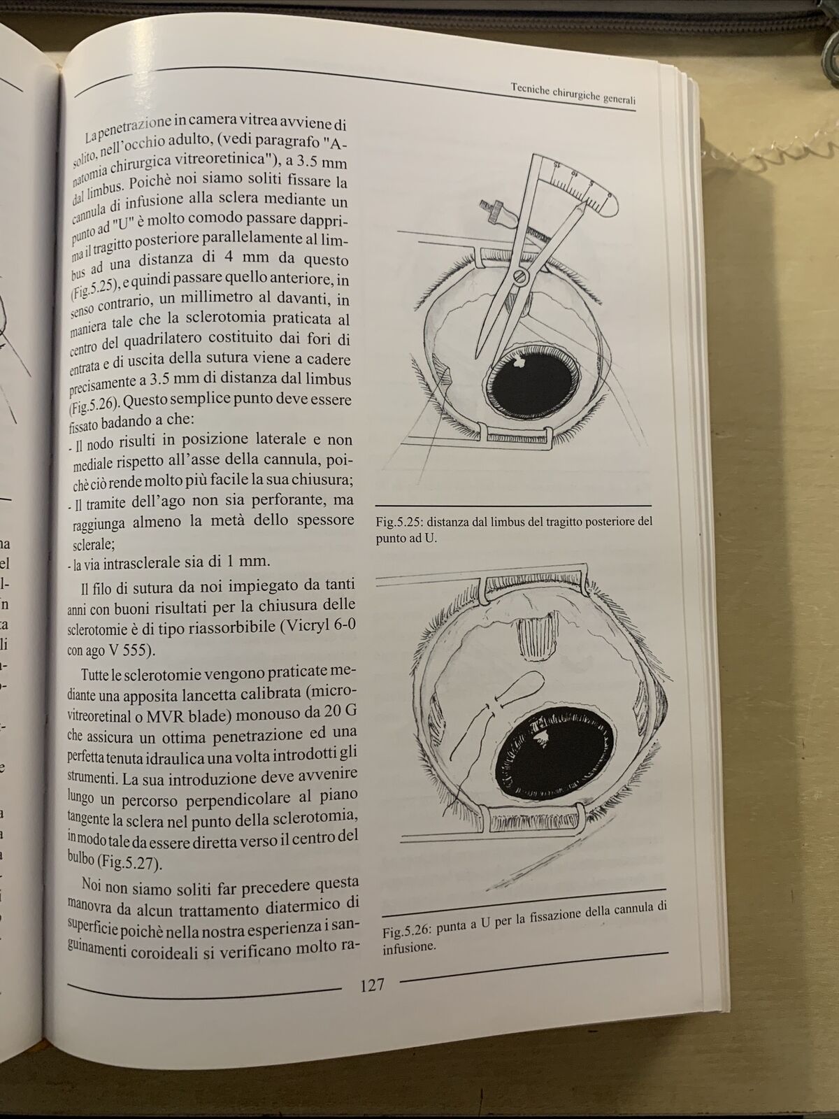 LA CHIRURGIA VITREORETINICA NEL DISTACCO DI RETINA REGMATOGENO. Molfetta Ghedini