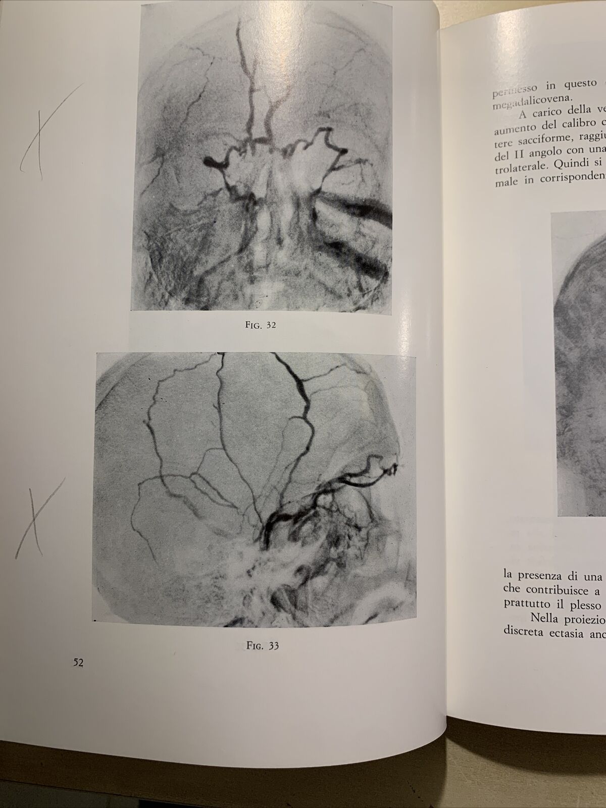 STATO ATTUALE DELLA FLEBOGRAFIA ORBITARIA - CRISTINI, CARAMAZZA, GIORDANO #