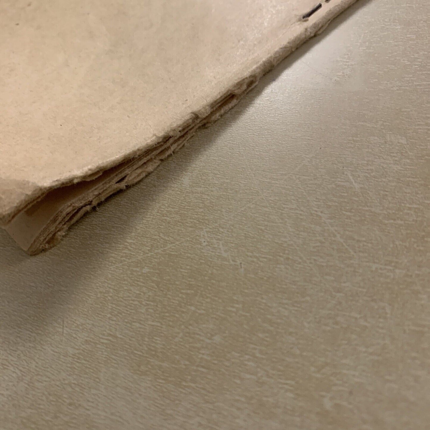 ANGIOMA CAVERNOSO DELL'ORBITA - Quirino di Marzio. Oculistica Oftalmologia 1923