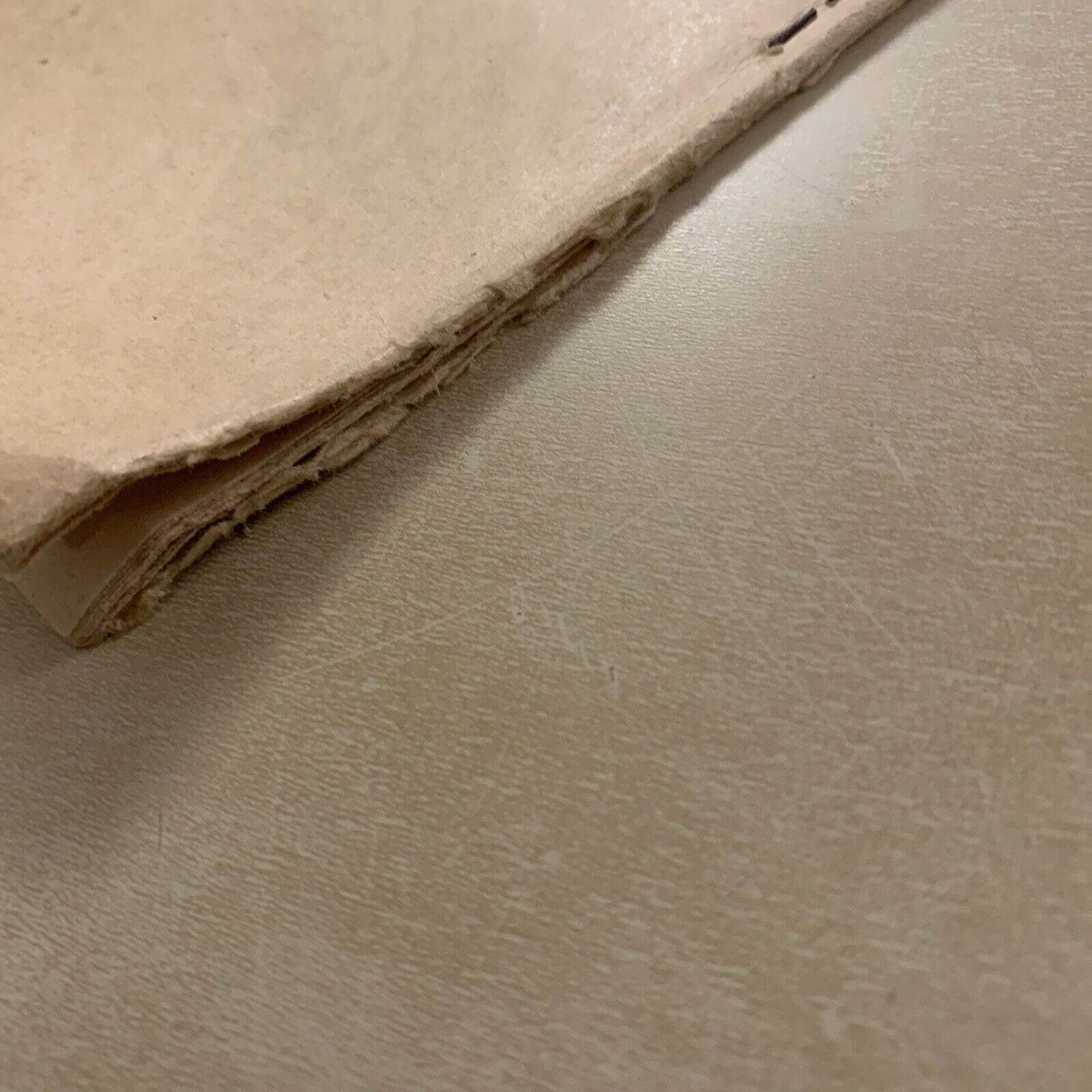 ANGIOMA CAVERNOSO DELL'ORBITA - Quirino di Marzio. Oculistica Oftalmologia 1923