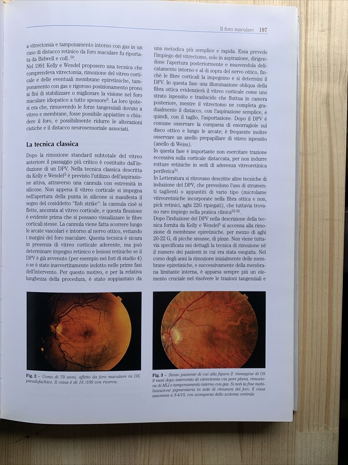 Chirurgia della Macula, Fabiano editore. Società oftalmologica italiana 2001 #