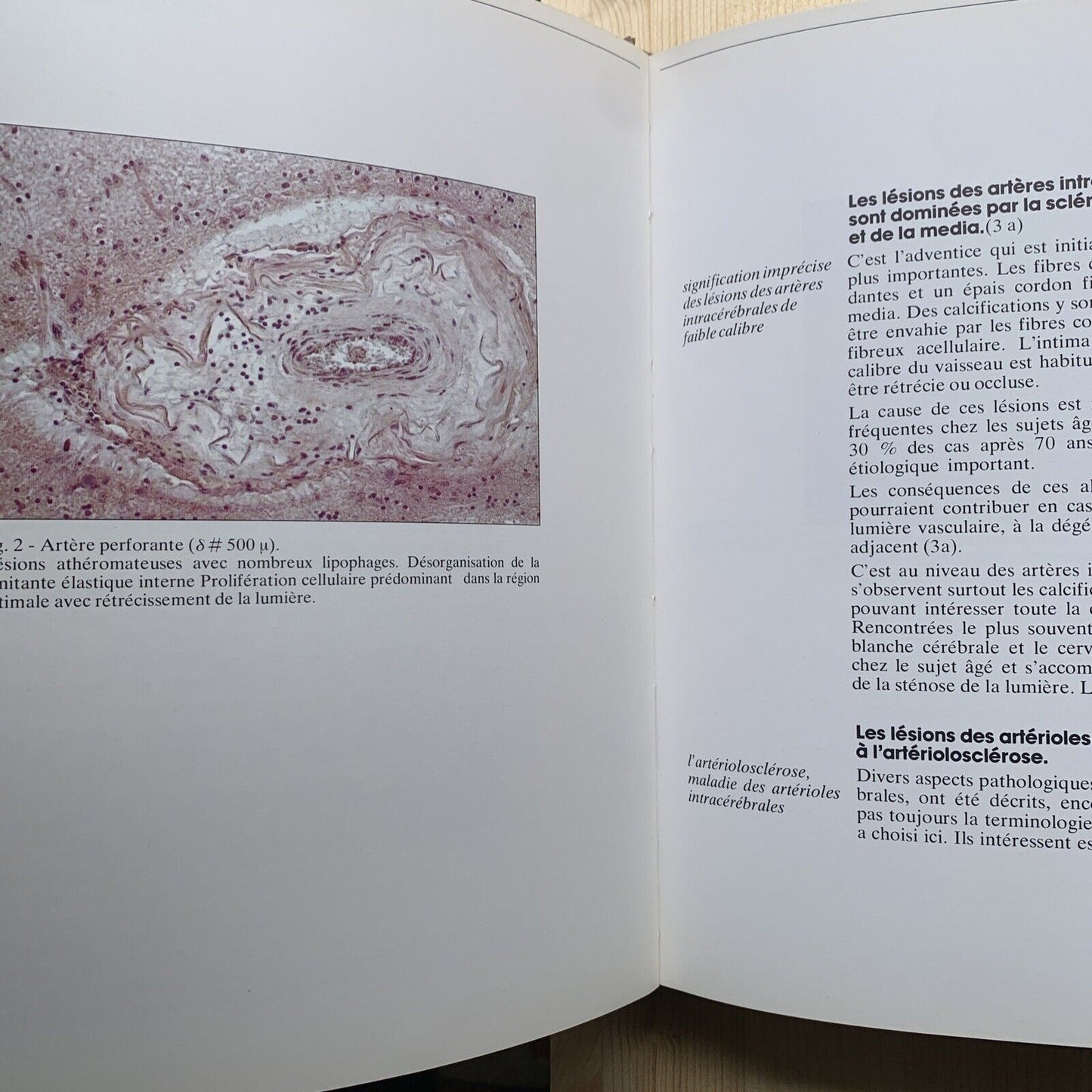 Redécouverte du micro anéurysme - Robert et Carrière, hypertension artirielle #
