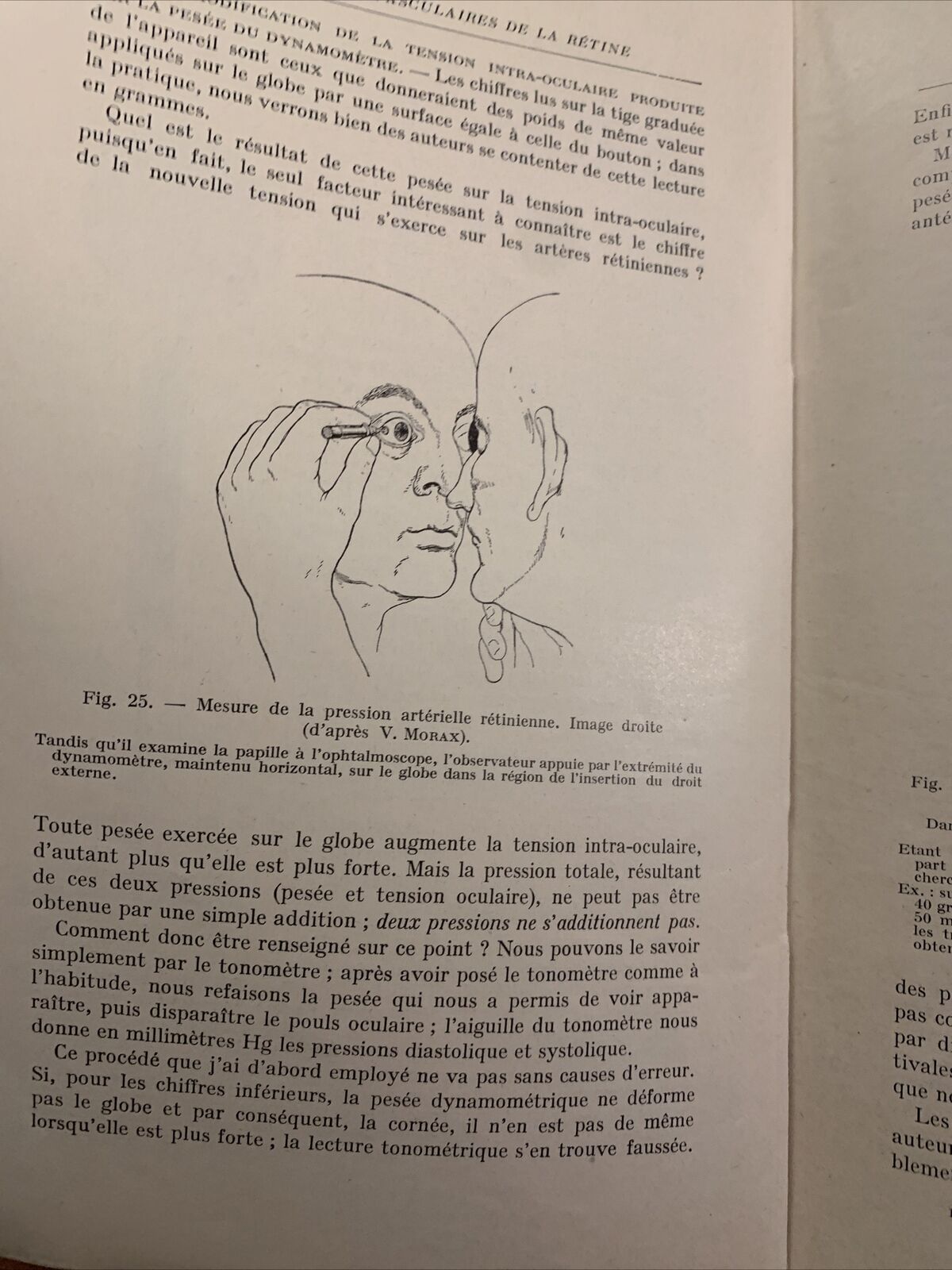 AFFECTIONS VASCULAIRES  DE LA RÉTINE - BAILLART. G. DOIN CIE #