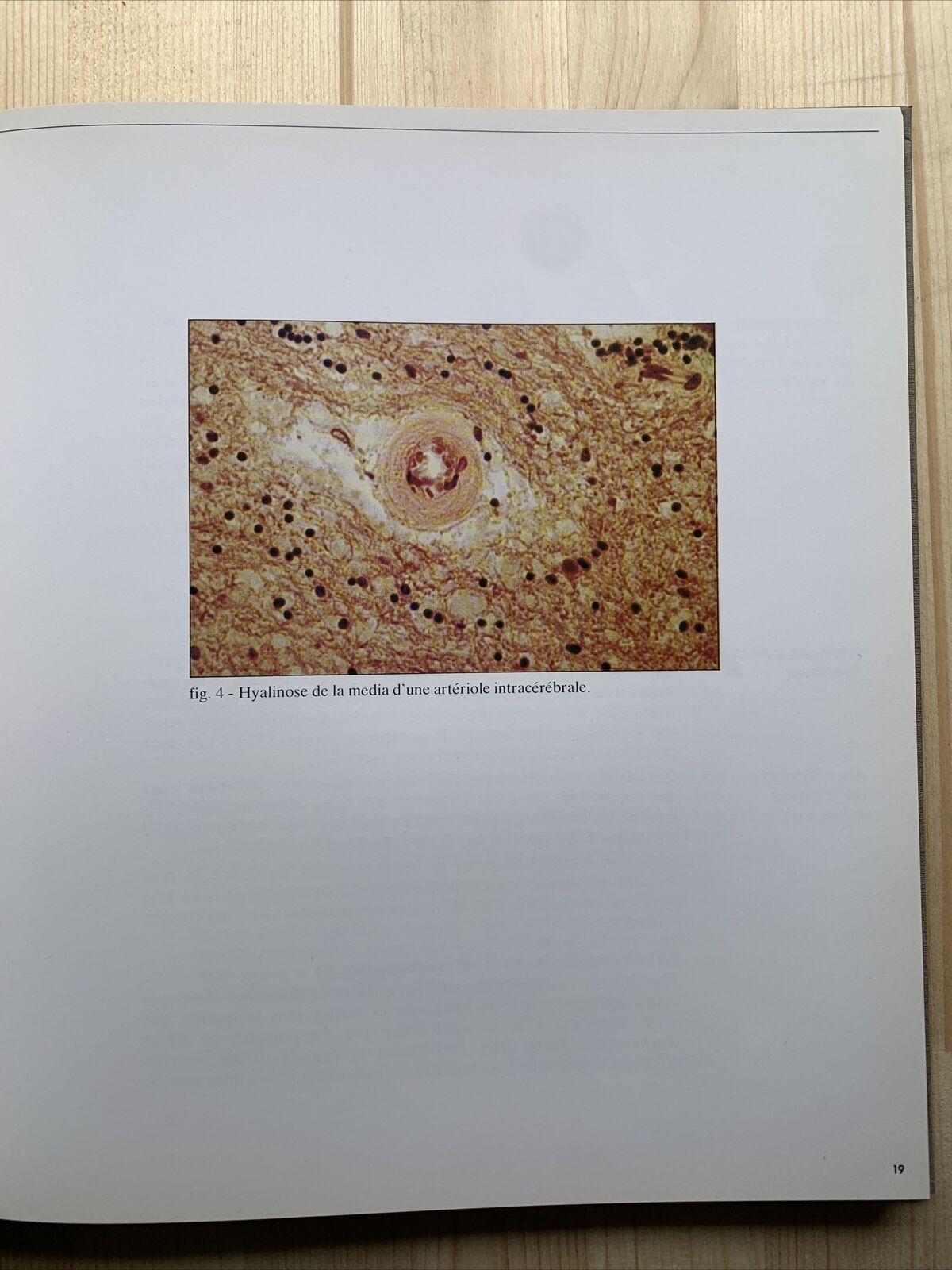 Redécouverte du micro anéurysme - Robert et Carrière, hypertension artirielle #