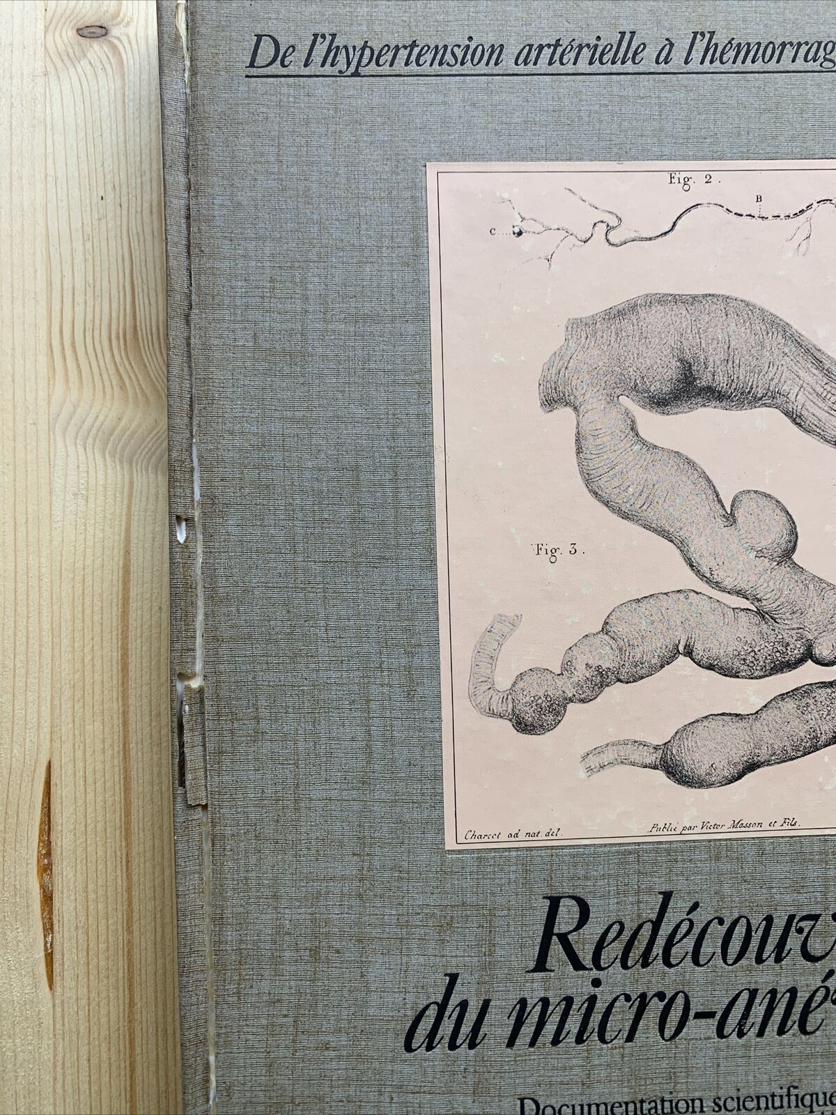 Redécouverte du micro anéurysme - Robert et Carrière, hypertension artirielle #