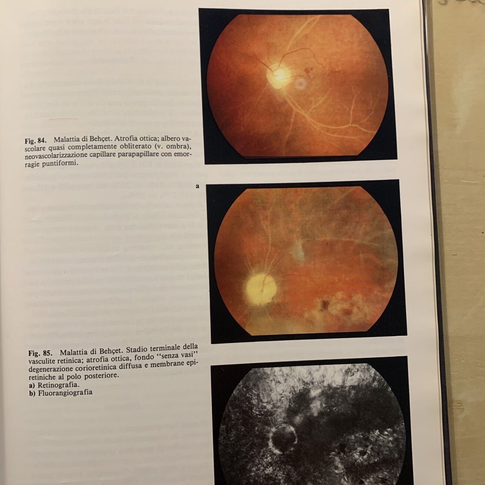 LE FLOGOSI UVEALI - PIVETTI PEZZI, MASSON 1987 #