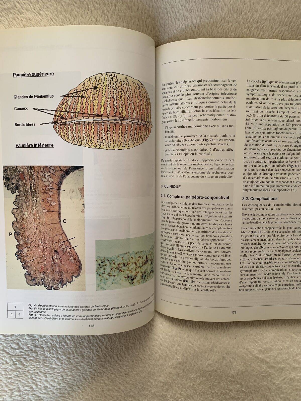 Inflammation chronique de la conjonctive, Thanh Hoang-Xuan, Hannouche, Badouin