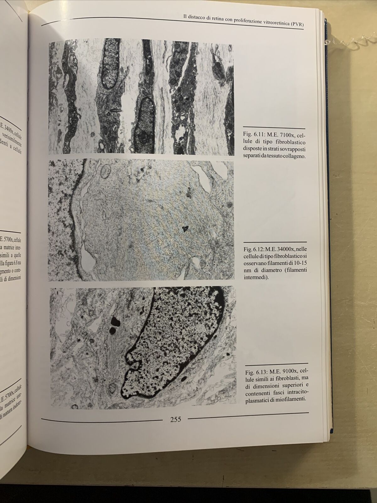 LA CHIRURGIA VITREORETINICA NEL DISTACCO DI RETINA REGMATOGENO. Molfetta Ghedini