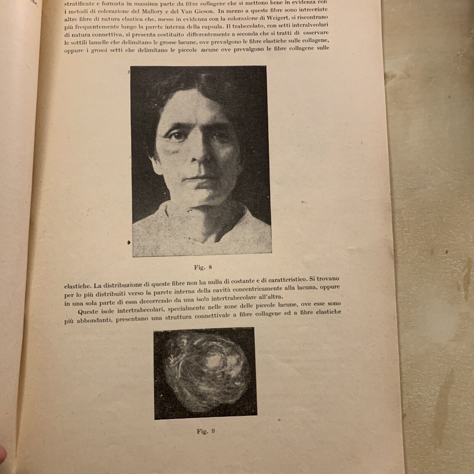 ANGIOMA CAVERNOSO DELL'ORBITA - Quirino di Marzio. Oculistica Oftalmologia 1923