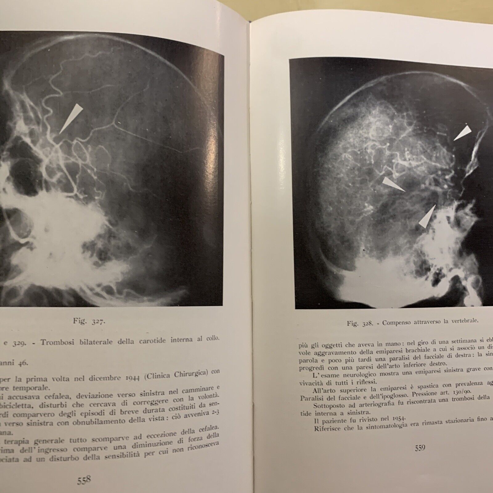 ANGIOGRAFIA CEREBRALE - MARIO MILLETTI, VOLUME PRIMO. LUIGI PARMA 1959