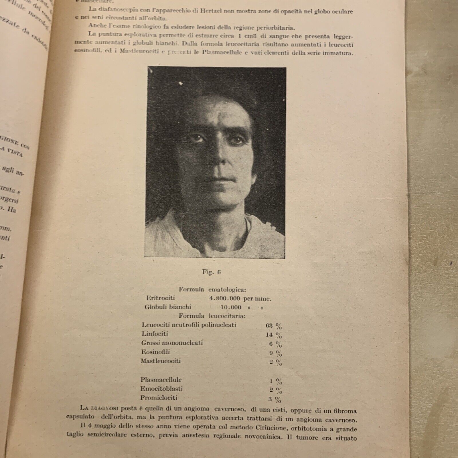 ANGIOMA CAVERNOSO DELL'ORBITA - Quirino di Marzio. Oculistica Oftalmologia 1923