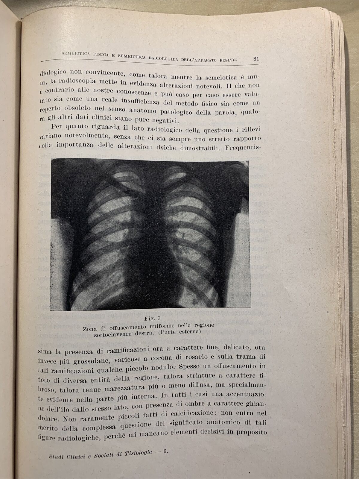 STUDI CLINICI E SOCIALI DI TISIOLOGIA - Giuseppe Ronzoni - Bareggi 1927 #