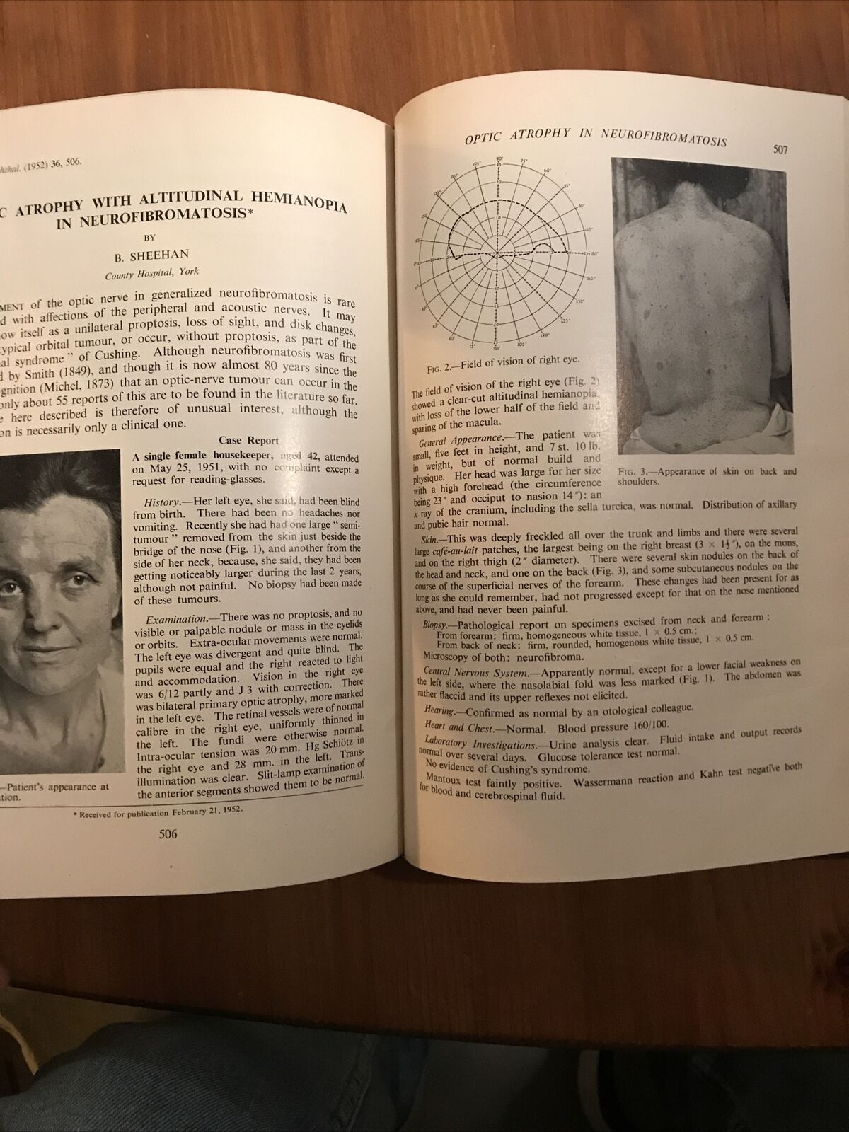 BRITISH JOURNAL OF OPHTHALMOLOGY oftalmologia, vol. XXXVI 1952 - S. Duke-Elder