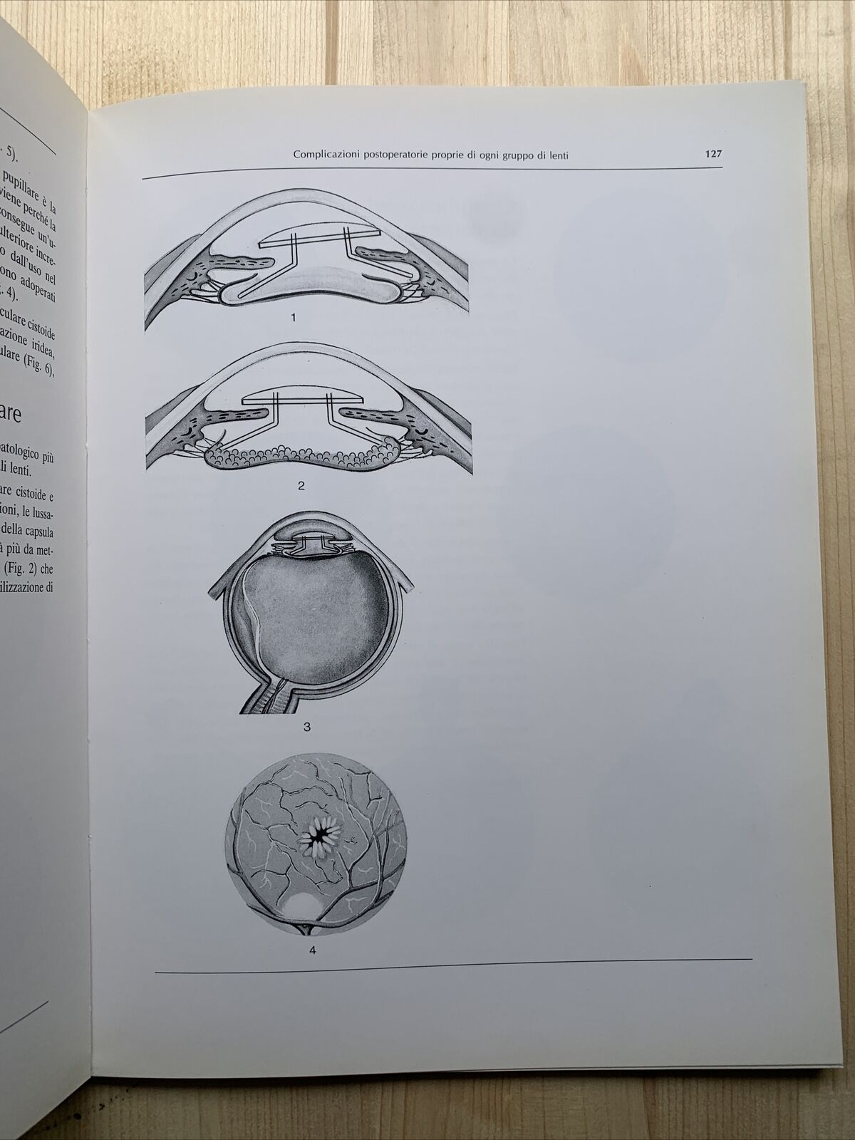 ATLANTE DI LENTI INTRAOCULARI - Lucio Buratto 1984 #