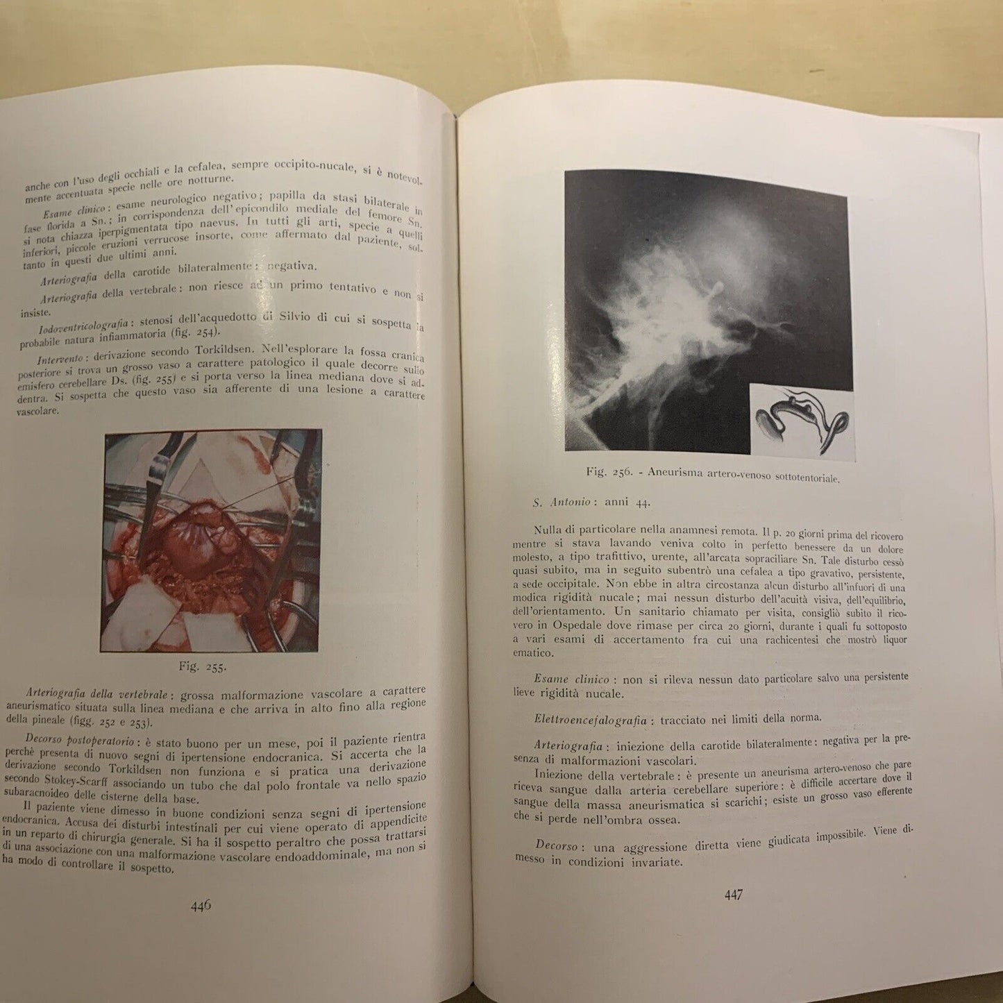 ANGIOGRAFIA CEREBRALE - MARIO MILLETTI, VOLUME PRIMO. LUIGI PARMA 1959