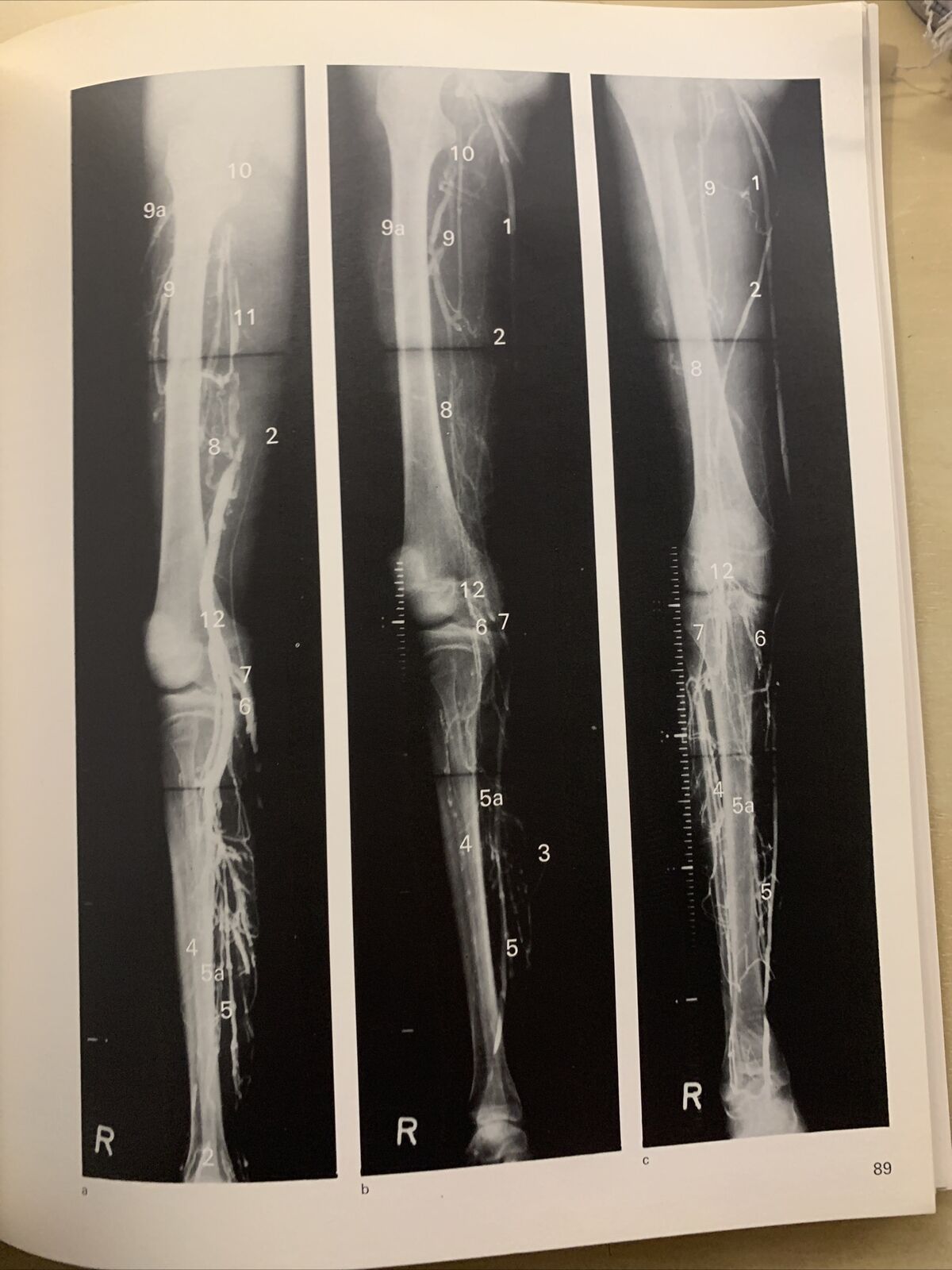 FORUM MEDICI - LES MÉDICINS PARLENT AU MÉDECIN, No 14 La phlébologie et les doma