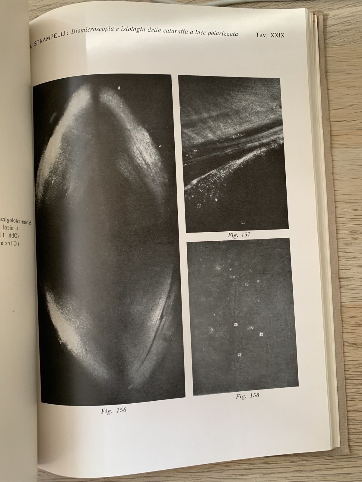 BIOMICROSCOPIA ED ISTOLOGIA DELLA CATARATTA A LUCE POLARIZZATA - Strampelli 1934