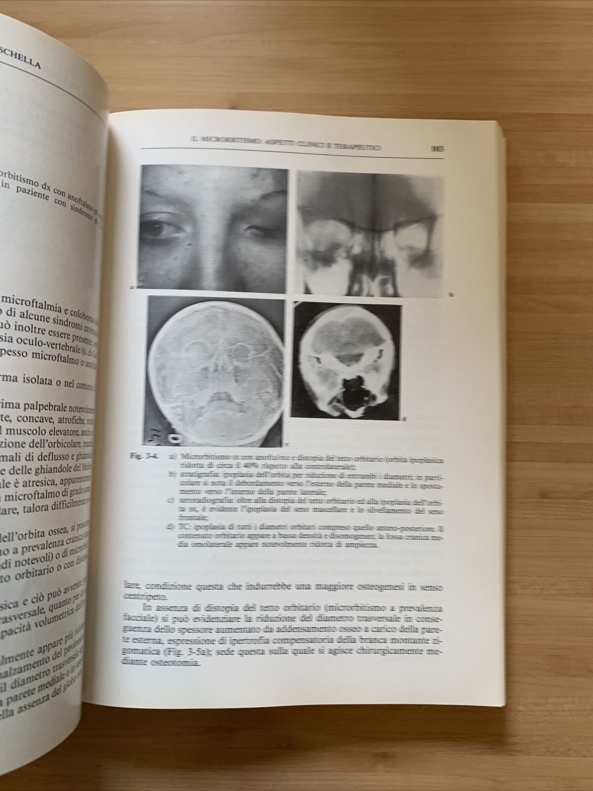 MALATTIE CONGENITE DELL'APPARATO OCULARE - Trattamento chirurgico. G. Scuderi