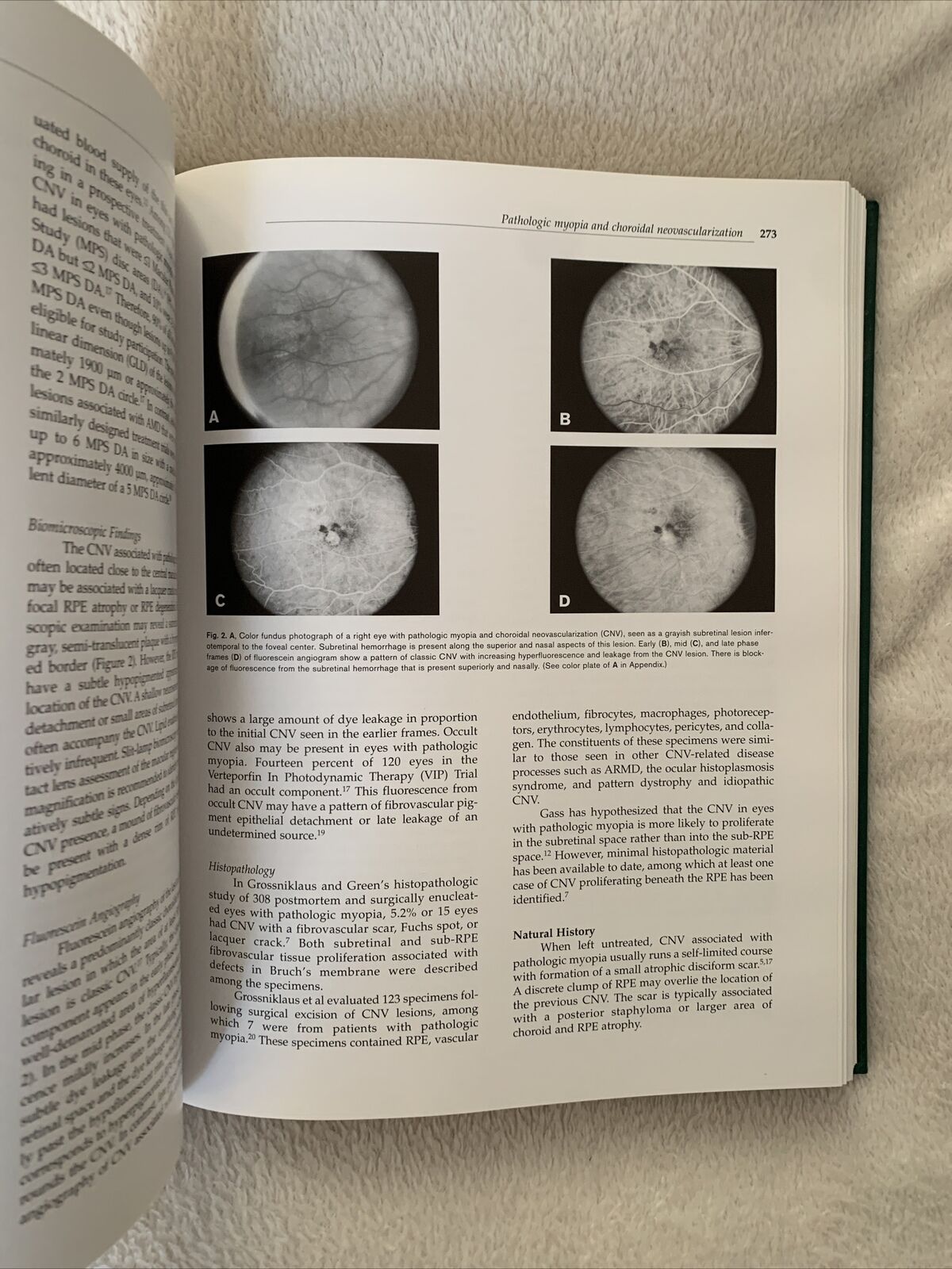 MYOPIA AND RELATED DISEASES. EDOARDO MIDENA. G. B. BIETTI 2005 OFTALMOLOGIA