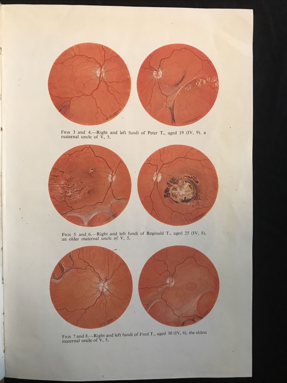 BRITISH JOURNAL OF OPHTHALMOLOGY, oftalmologia. Stewart Duke-Elder 1951 vol XXXV