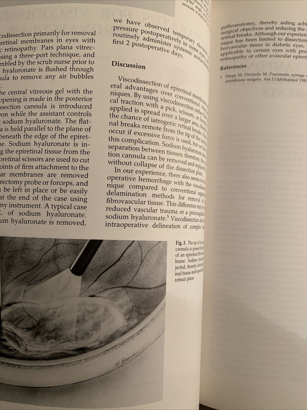 ADVANCES IN VITREORETINAL SURGERY. G.B BIETTI. MARIO STIRPE 1992