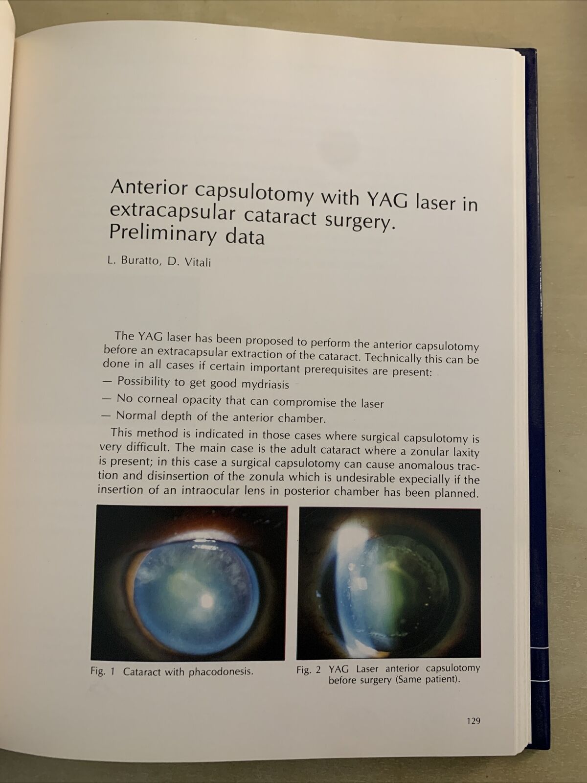 ND: YAG LASER APPLICATIONS - LUCIO BURATTO. OFTALMOLOGIA - ophthalmology