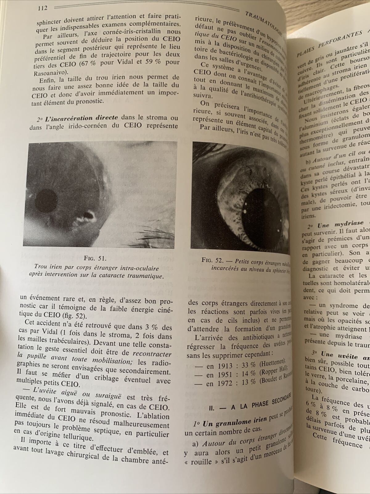 Plaies et contusions du segment anterieur de l'oeil. C. Boudet. Ophtalmologie #