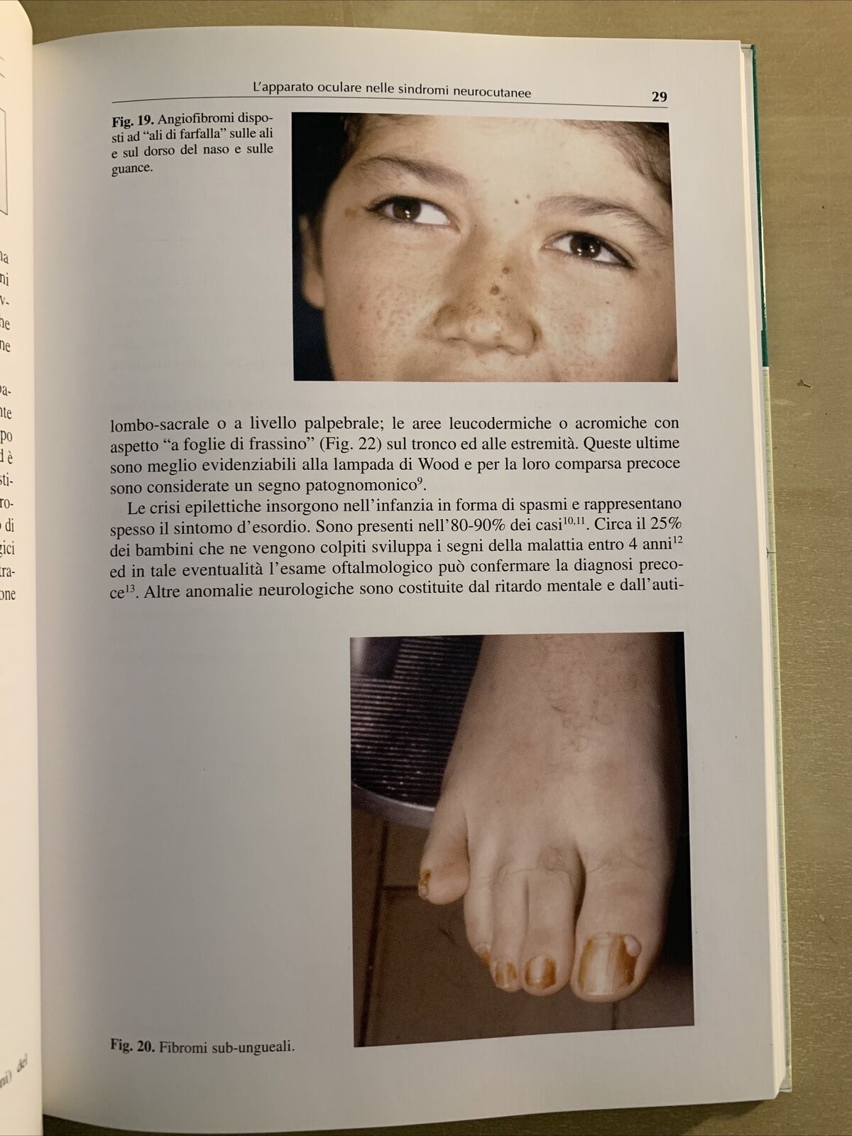 L'APPARATO OCULARE NELLE SINDROMI NEUROCUTANEE - Santi Maria recupero. Verduci #