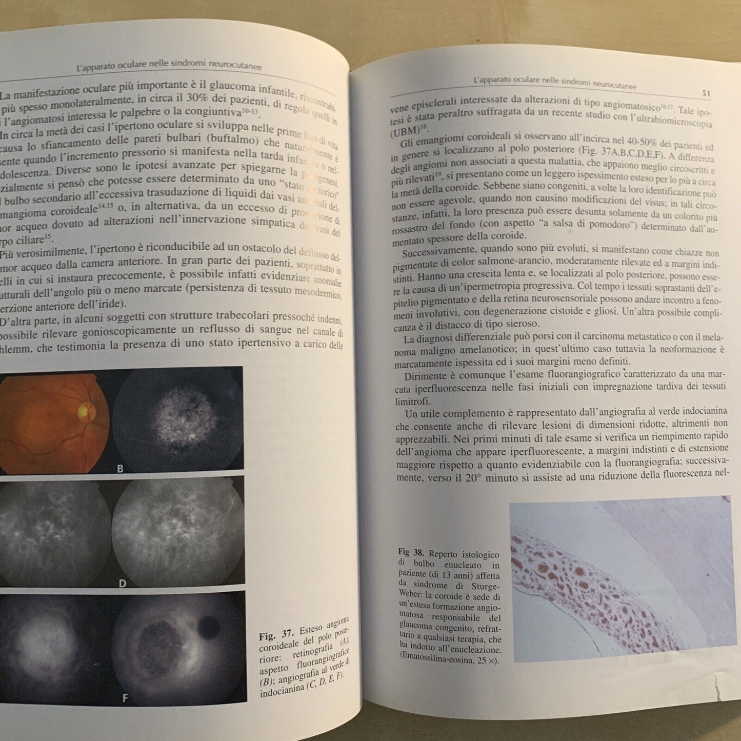 L'APPARATO OCULARE NELLE SINDROMI NEUROCUTANEE - Santi Maria recupero. Verduci #