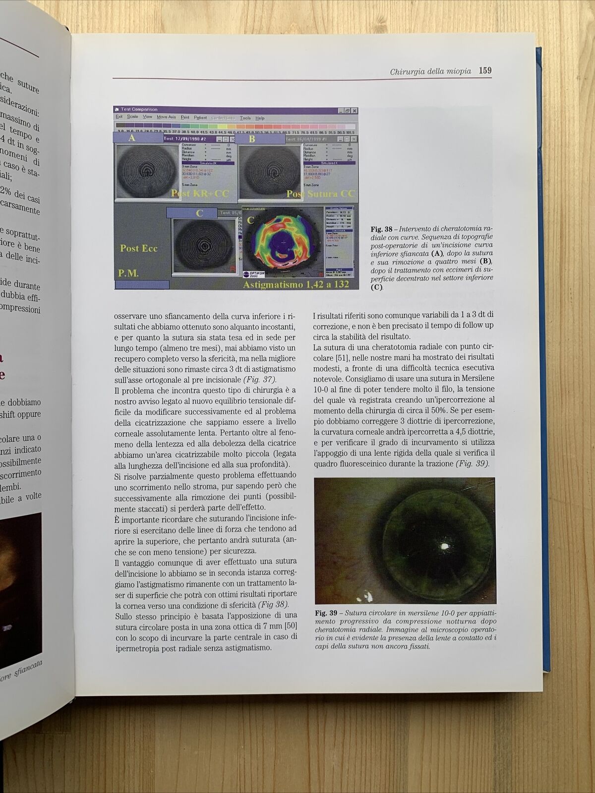 Chirurgia Refrattiva, Principi e Tecniche. Fabiano AICCER, OFTALMOLOGIA - 2000 #