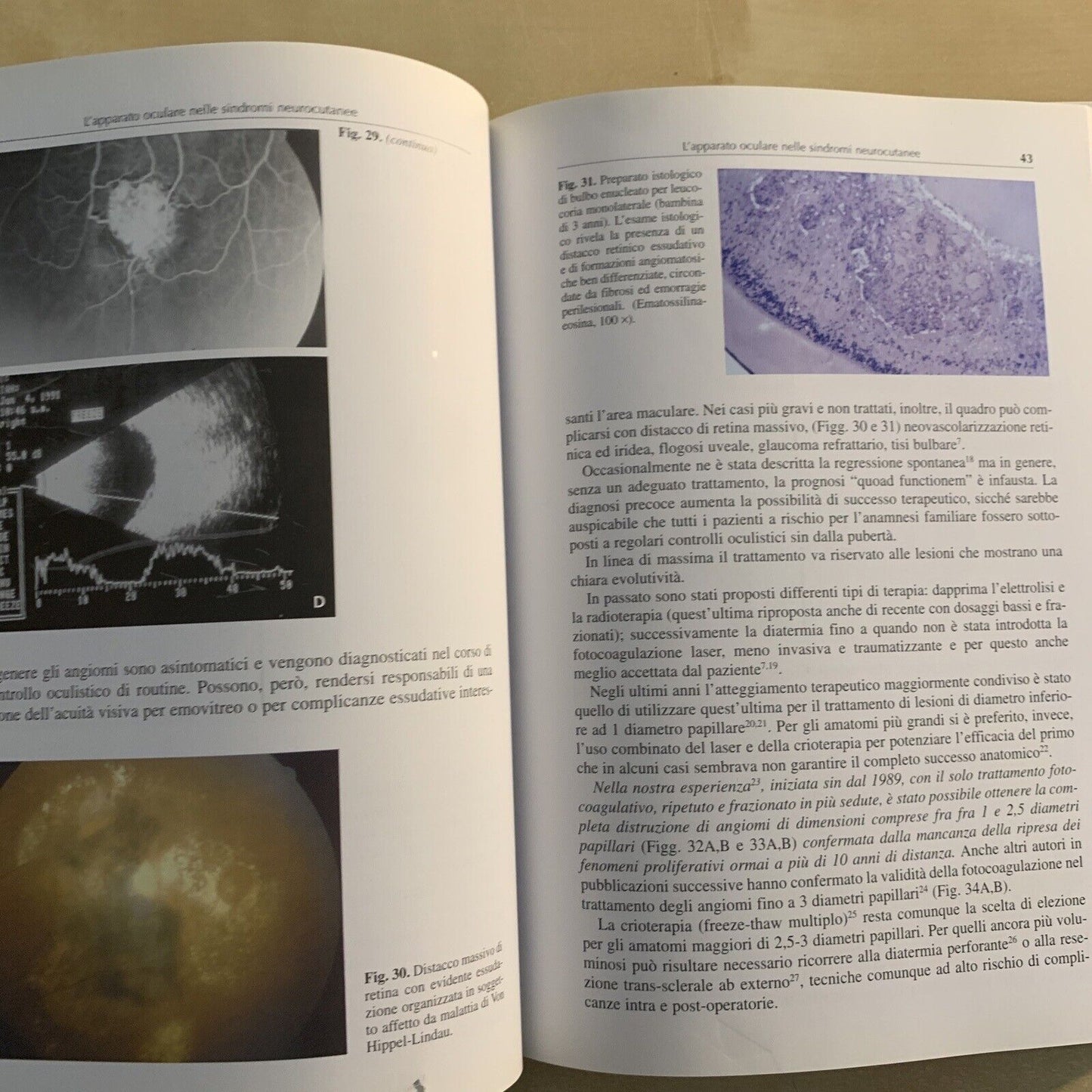 L'APPARATO OCULARE NELLE SINDROMI NEUROCUTANEE - Santi Maria recupero. Verduci #